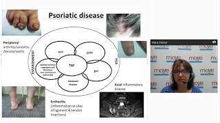 The Diagnosis and Management of Psoriatic Arthritis [upl. by Violet]