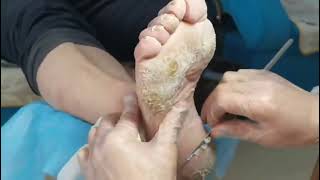 Cracked Heels So satisfying 9 mins Dead skin removal and Cracked heel treatment [upl. by Charlot]