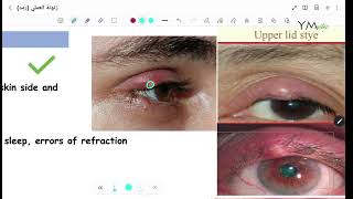 Eyelid Diseases OPH [upl. by Ydnem]