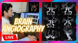 Live CT Scan Of Brain Angiography Scanning and processing technique radiologytechnologist ctscan [upl. by Ellehsad]