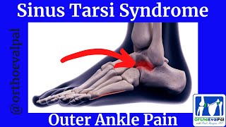 Sinus Tarsi Syndrome Outer Ankle Pain [upl. by Einneg]