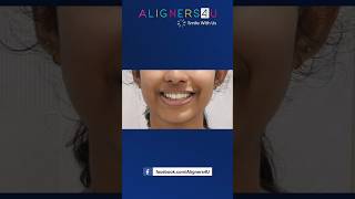 Invisible Aligners Journey  Clear Aligners Hyderabad  Braces  Smile Makeover  Aligners4U [upl. by Gilcrest454]