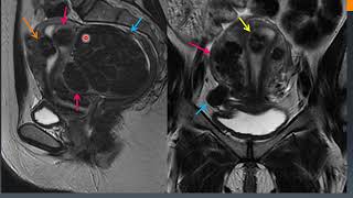 Diagnostico por imágenes Patología miometrial y endometrial [upl. by Llenrub]