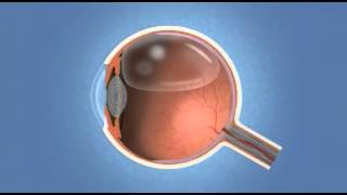 Vitrectomy  Eye Associates of Colorado Springs [upl. by Traver145]