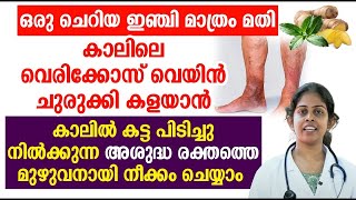 ഒരു ചെറിയ ഇഞ്ചി മാത്രം അതി കാലിലെ വെരിക്കോസ് വെയിൻ ചുരുക്കി കളയാൻ  Varicose veins Malayalam [upl. by Roselin337]