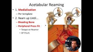 Total Hip Arthroplasty Indications and Instrumentations [upl. by Lorn206]