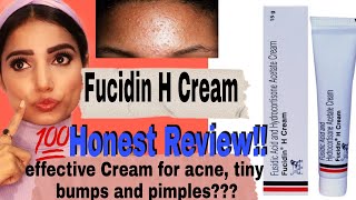 Fucidin H Cream 100 Honest Review amp Uses  Say no to Tiny Bumps  Acne and Pimples  Myra Sharma [upl. by Dyl]