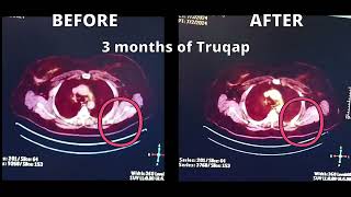 TRUQAP 3 Month Review  Stage 4 Breast Cancer Treatment  Living With Metastatic Breast Cancer [upl. by Anaehs997]