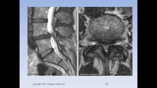 Lumbar Spinal Stenosis Cauda Equina Syndrome Sciatica amp Disc Herniation An Advanced Lecture [upl. by Nagaek]