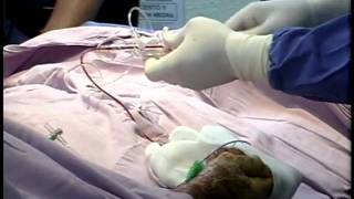 CASO CLINICO EN VIVO DE ANGIOPLASTIA CORONARIA POR VIA RADIAL 3a PARTE [upl. by Asiram935]