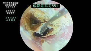 采耳哥Thick and dry slices of external auditory meatusearwax asmr drzhao ｜551 [upl. by Skerl922]