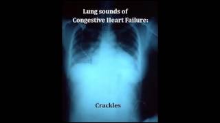 lung sounds  crackles [upl. by Leizo]