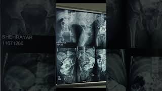 XRAY  Barium Enema  Hirschsprung Disease  Megacolon  Intestinal Obstruction  Ultrasound [upl. by Helgeson]