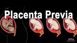 Low Lying Placenta  Placenta Previa Animation [upl. by Aisor381]