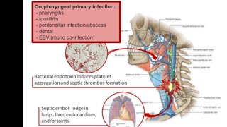 Mystery diagnosis lemierres disease [upl. by Brenan]