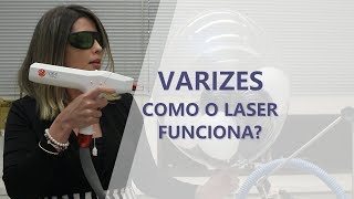 Tratamento de Varizes  Como Funciona o Laser  Dra Livia Lyra  Angiologista Belo Horizonte [upl. by Fiorenza892]