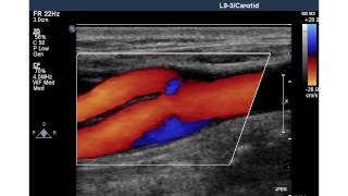 NORMAL CAROTID ARTERY [upl. by Gordan855]