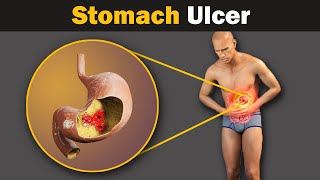 What causes a stomach ulcer Animation [upl. by Grefer966]