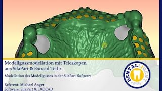 TUTORIAL  TEASER SilaPart amp EXOCAD Modellation von Teleskopen und MoGu Teil2 Taeser [upl. by Lowis47]