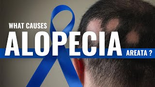 What Causes Alopecia Areata Explained By DrAsif [upl. by Peterman]