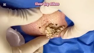 Big Cystic Acne Blackheads Extraction Blackheads amp Milia Whiteheads Removal Pimple Popping [upl. by Lesnah288]