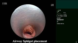 Hemoptysis Bronchoscopic endobronchial sphigot  Watanabe  placement with Glue instillation [upl. by Etti]