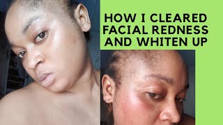 How To Get Rid Of Facial Redness To Make Effective Sunburn Acne Spots Face Cream Skin Whitening [upl. by Annez]