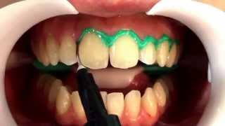 Clareamento dentário com Whiteness HP Blue FGM [upl. by Dimond]