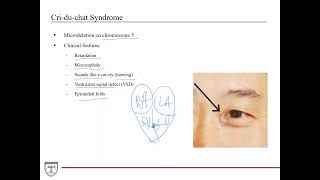 Microdeletion Syndromes  Criduchat Williams Syndrome DiGeorge Syndrome Genetics 3 of 8 [upl. by Hallette68]