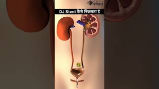 DJ Stent Removal  Retrograde Intrarenal Surgery  kidney stone treatment shorts [upl. by Noid]