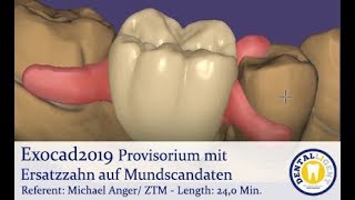 EXOCAD 2019  Tutorial Preview  Provisorium mit Ersatzzahn auf Mundscandaten [upl. by Misa]