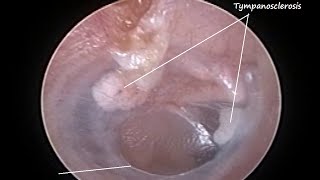 Otoendoscopy  Naturally healed central perforation of eardrum with Tympanosclerosis [upl. by Anah]