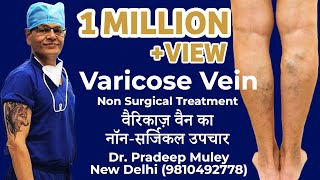 Varicose vein treatment procedure MicrowaveRFALaser Ablation Surgery [upl. by Ilise]