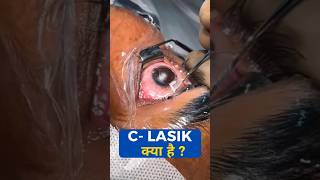 What Is C Lasik [upl. by Atiluap]