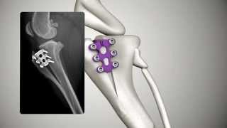 Tibial Tuberosity Advancement TTA RAPID [upl. by Caassi]