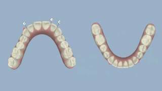 Invisalign  Midline Shift and IPR  Dr Thomas Gibbs DDS [upl. by Eiro160]