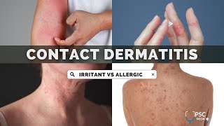 Irritant Contact Dermatitis vs Allergic Contact Dermatitis  Dermatology  UPSC MEDICO [upl. by Mcadams]