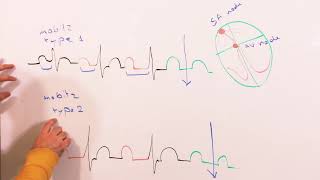 Av block Type 1 Mobitz IWenckebach and Mobitz 2 انحباس العقدة الأذينية البطينية [upl. by Lynd317]