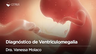 Diagnóstico de Ventriculomegalia  Dra Vanessa Molaco [upl. by Noned]