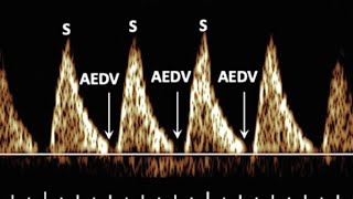 Severe Fetoplacental insufficiencyAbsent diastolic flow on umbilical artery Doppler [upl. by Truda]