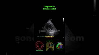 Ecocardiografía  Hipocinesia Inferolateral E Inferior [upl. by Hgierb]