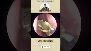 rhinorrhea sinusitis bersihkankuping satisfyingvideos pembersihan telinga video puas hati [upl. by Platus]