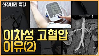 신장특강 고혈압을 일으키는 원인 이차성 고혈압 2 섬유근육형성이상 Fibromuscular dysplasia [upl. by Bogart833]