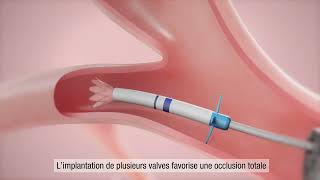 La valve endobronchique Zephyr® pour les personnes atteintes de BPCO et demphysème Français [upl. by Sharma]