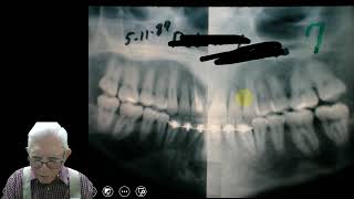 Adult Orthodontics  Root Resorption [upl. by Tiphane362]