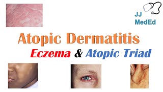 Contact Dermatitis Explained dermatitis [upl. by Germain]