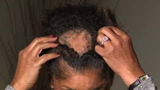 What Is Causing This Woman’s Extreme Hair Loss [upl. by Seuqramed]