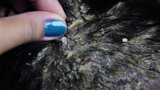 dandruff removal huge flakes scratching on head32 [upl. by Kara-Lynn]