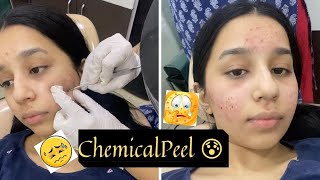 My First Chemical Peel Treatment For Acne  My Experience Of 7 Days with Pictures [upl. by Nrevel]