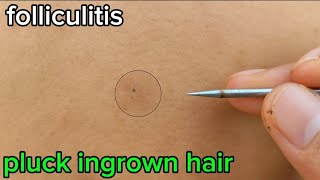 PLUCKING INGROWN BACK HAIR because folliculitis for Mr yvavksidvbsn [upl. by Mathilda]